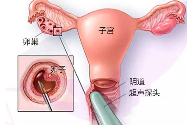 武汉助孕公司